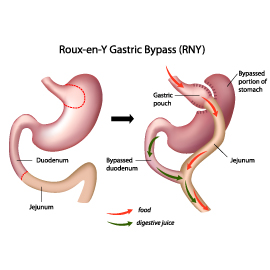 Gastric Bypass Surgery for Weight Loss
